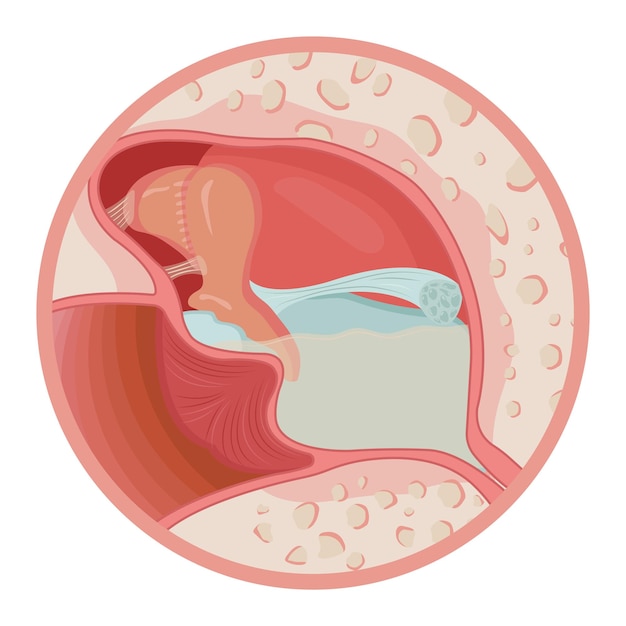 oorontsteking met vloeistoffen vectorillustratie