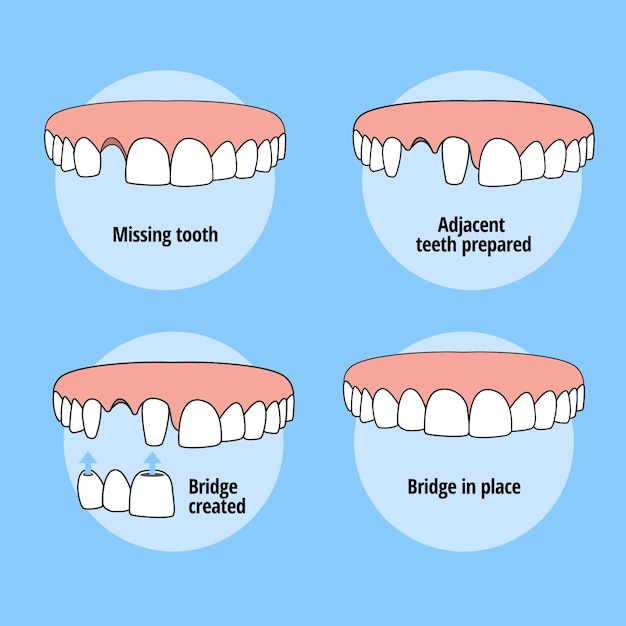 Oplossing voor tandverlies tanden fixeren brugplaatsingsproces mondverzorging