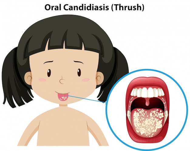 벡터 소녀에 구강 칸디다증 thursh