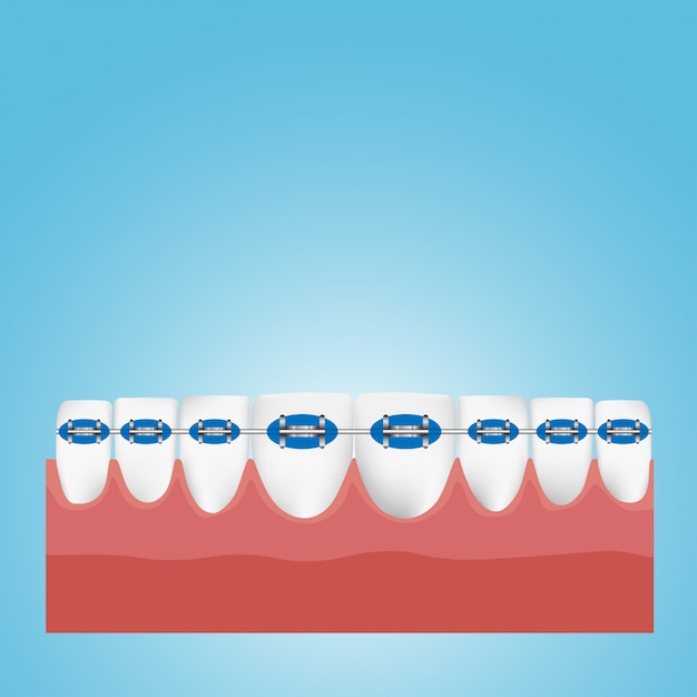 Vector orthodontics teeth or dental braces