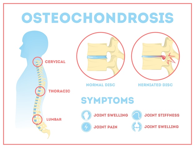 Vector osteochondrose anatomische infographic. lumbaal, cervicaal en thoracaal