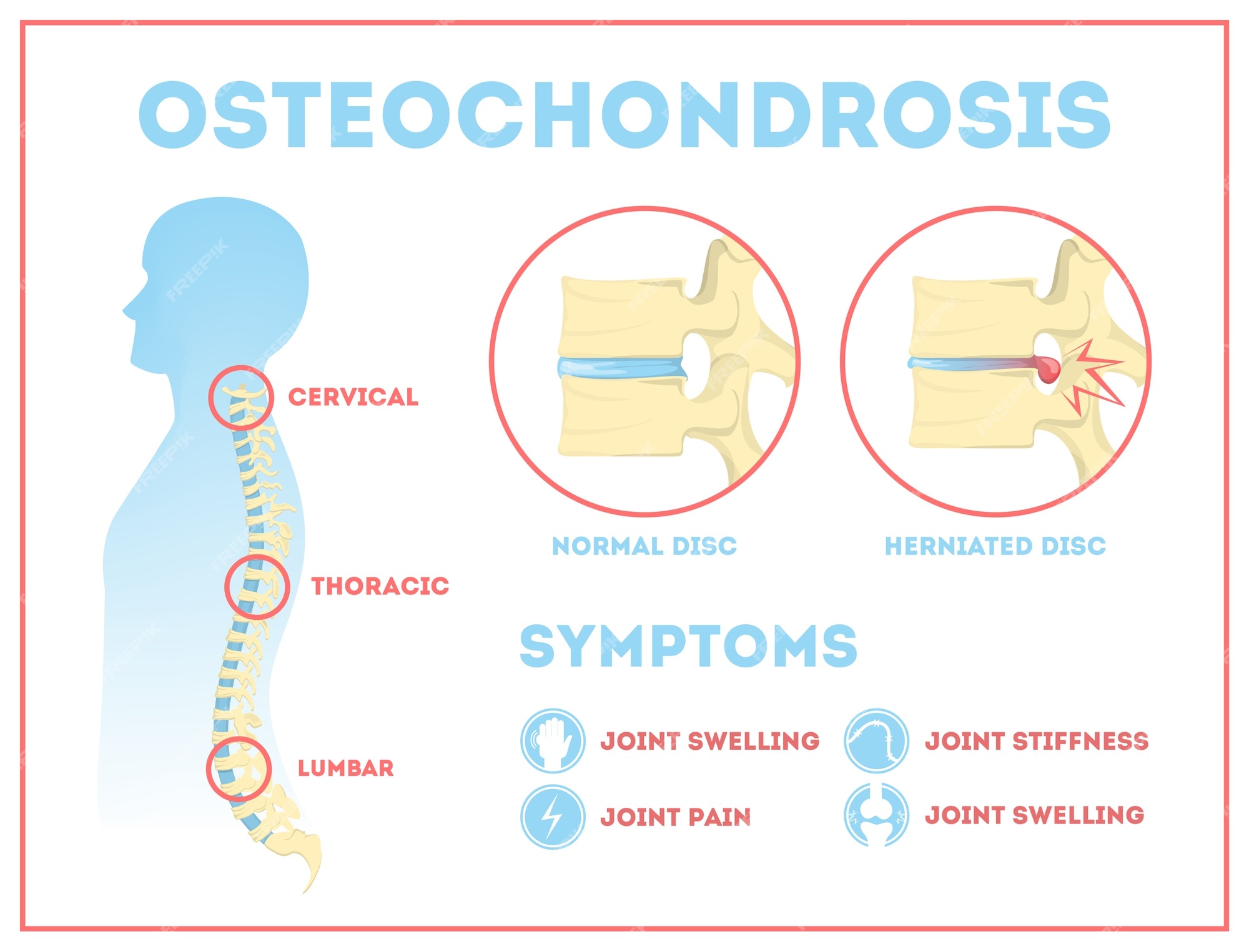 A bordák ízületeinek osteochondrosis - A bordaporcgyulladás lehetséges okai