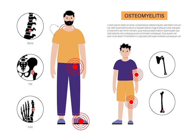 Osteomyelitis bij volwassenen en kinderen Geïnfecteerde botten van de wervelkolom, benen en armen De infectie verspreidt zich via de bloedbaan naar de botten Staphylococcus aureus-bacteriën in het menselijk lichaam