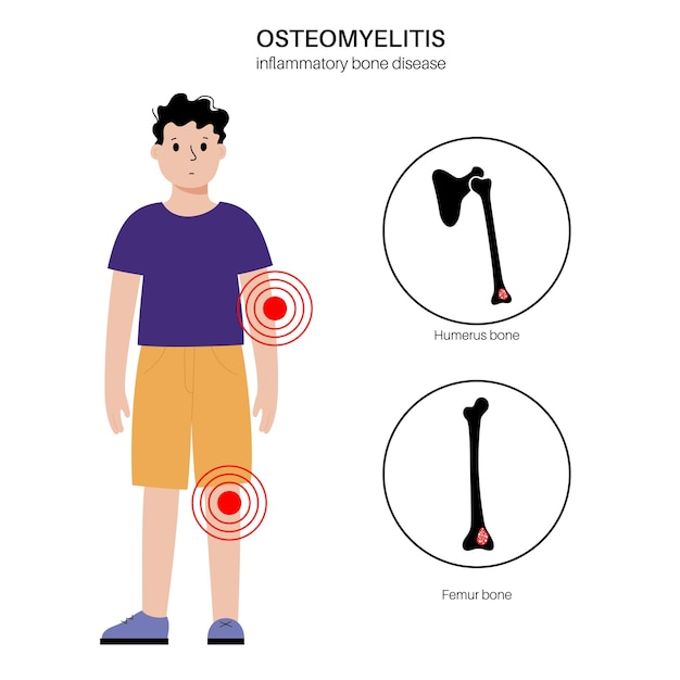 Vector osteomyelitis disease in children common cases infected bones of arms and legs infection spreads through the bloodstream into the humerus and femur bones bacteria in the young body medical vector