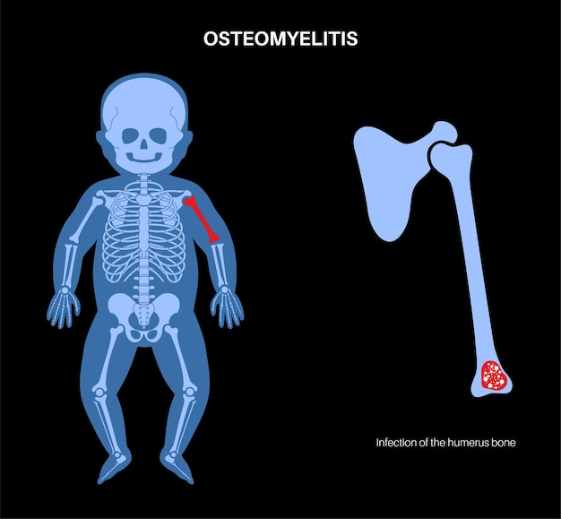 Vector osteomyelitis disease in children infected bone of arm infection spreads through the bloodstream into the humerus bone staphylococcus aureus bacteria in the infant body medical vector illustration