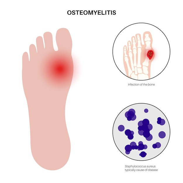 Osteomyelitis disease Infected feet bones pain and overlying redness Infection spreads through the bloodstream into the foot Staphylococcus aureus bacteria in the human body vector illustration