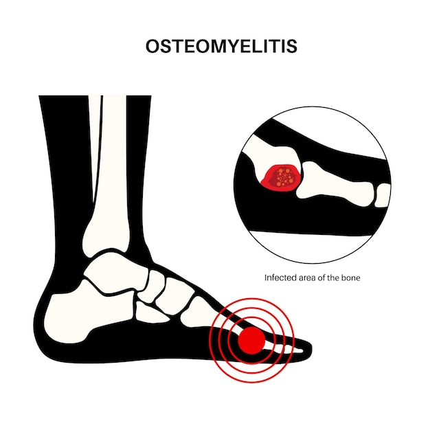 Osteomyelitis disease infected feet bones pain and overlying redness infection spreads through the bloodstream into the foot staphylococcus aureus bacteria in the human body vector illustration