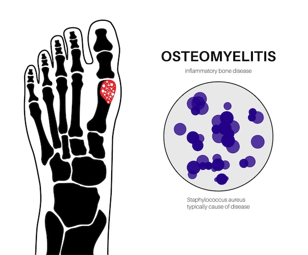 Vector osteomyelitis disease infected feet bones pain and overlying redness infection spreads through the bloodstream into the foot staphylococcus aureus bacteria in the human body vector illustration