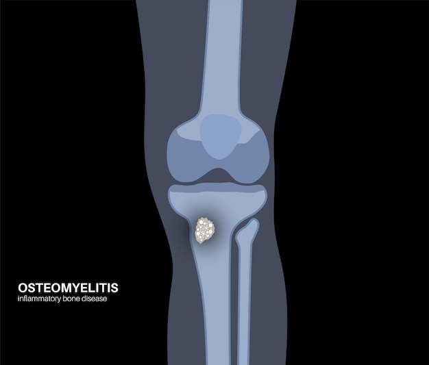 Vector osteomyelitis disease infected knee dead bones pain and overlying redness infection spreads through the bloodstream into tibia staphylococcus aureus bacteria in the human body vector illustration