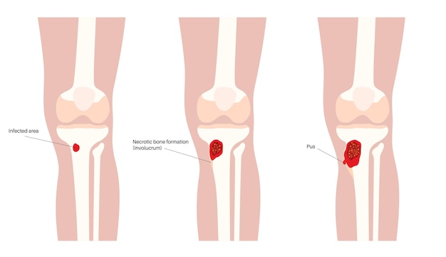 Osteomyelitis disease Infected knee dead bones pain and overlying redness Infection spreads through the bloodstream into tibia Staphylococcus aureus bacteria in the human body vector illustration