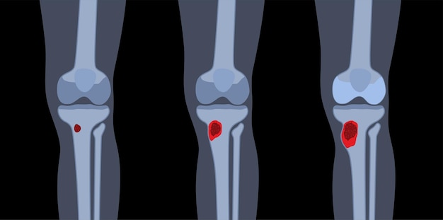 Osteomyelitis ziekte Geïnfecteerde knie dode botten pijn en bovenliggende roodheid Infectie verspreidt zich via de bloedbaan naar het scheenbeen Staphylococcus aureus bacteriën in het menselijk lichaam vectorillustratie