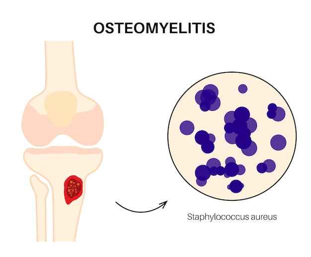 Osteomyelitis ziekte geïnfecteerde knie dode botten pijn en bovenliggende roodheid infectie verspreidt zich via de bloedbaan naar het scheenbeen staphylococcus aureus bacteriën in het menselijk lichaam vectorillustratie