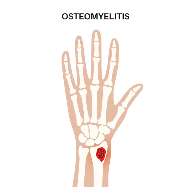 Osteomyelitis ziekte Geïnfecteerde pijn in de armbeenderen en bovenliggende roodheid Infectie verspreidt zich via de bloedbaan naar de pols Staphylococcus aureus bacteriën in het menselijk lichaam vectorillustratie