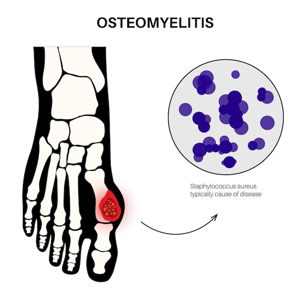 Vector osteomyelitis ziekte geïnfecteerde voeten botten pijn en bovenliggende roodheid infectie verspreidt zich via de bloedbaan naar de voet staphylococcus aureus bacteriën in het menselijk lichaam vectorillustratie