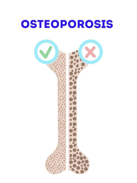 Vector osteoporose vectorillustratie. medische orthopedische poster met afbeelding van botten