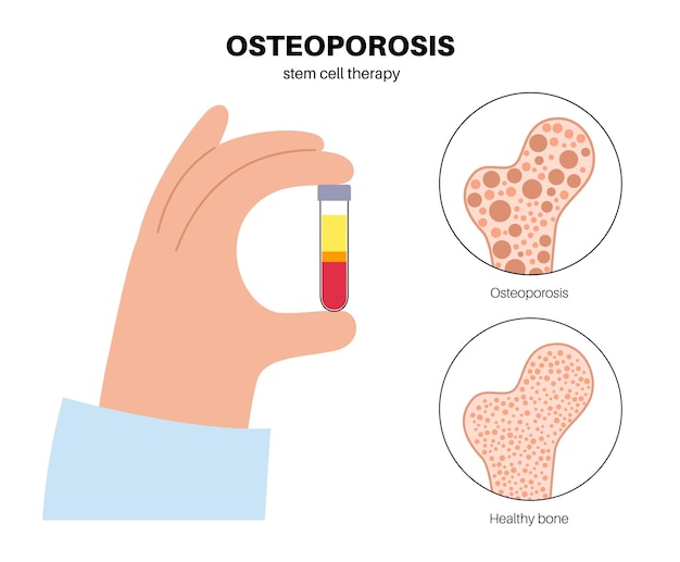 Вектор Лечение заболевания остеопорозом стволовыми клетками