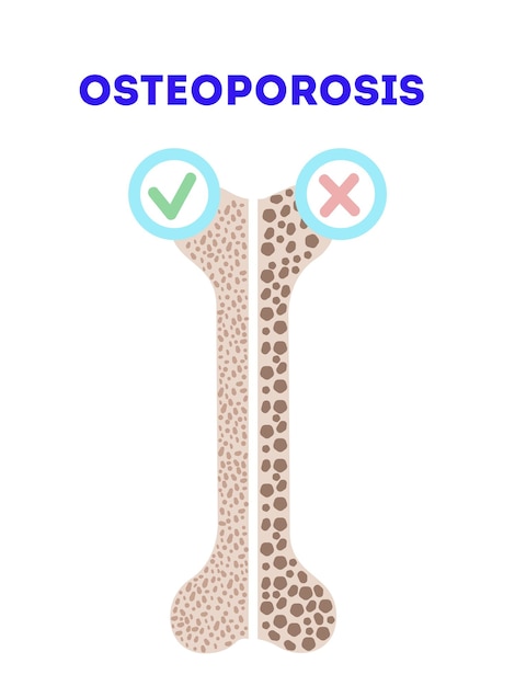 Векторная иллюстрация остеопороза. медицинский ортопедический плакат с изображением костей