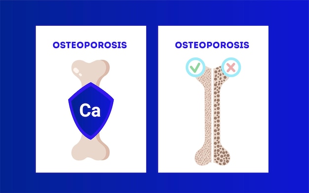 Vettore di osteoporosi poster medici ortopedici con un'illustrazione delle ossa