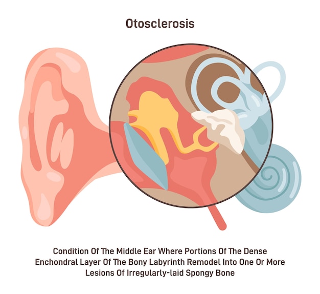 Vector otosclerosis medical condition of the middle ear bones inside