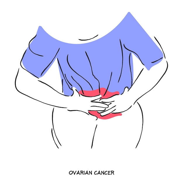 Illustrazione del cancro ovarico