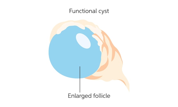 Vector ovarian cysts in women