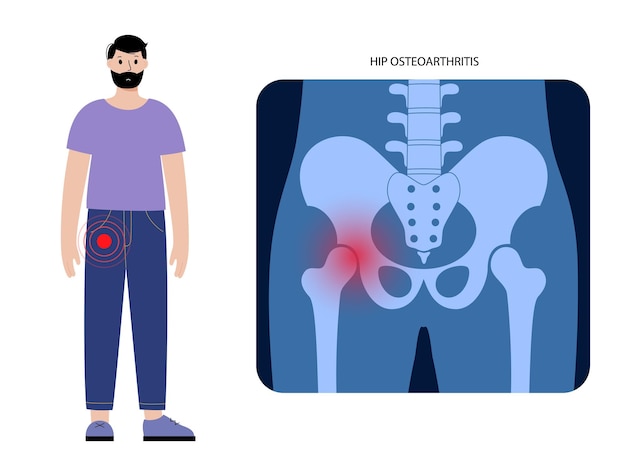 Pain in hip or pelvis. Skeleton x ray silhouette medical poster. Joints and cartilage