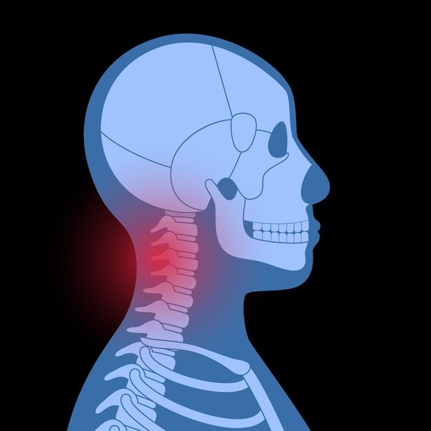 Vector pain in neck or spine bones. skeleton x ray silhouette poster. joints and cartilage in human body