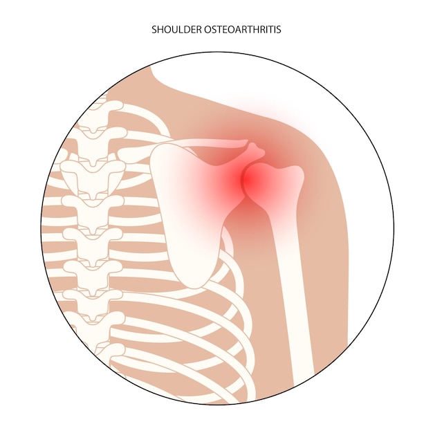 Pain in shoulder or scapula. Skeleton xray silhouette. Joints and cartilage in human body. Arthritis