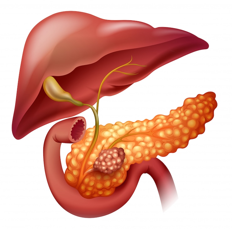 Vector pancreas cancer diagram on white