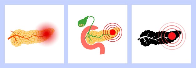 Vettore malattia del pancreas e cancro