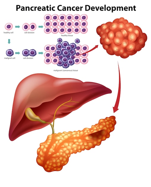 Infografica sullo sviluppo del cancro al pancreas