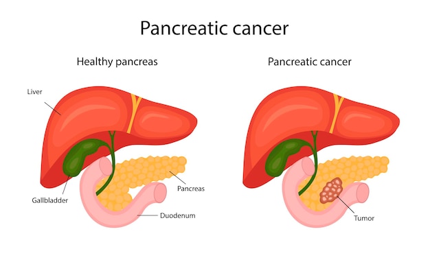 Cancro del pancreas. infografiche. illustrazione in stile cartone animato.