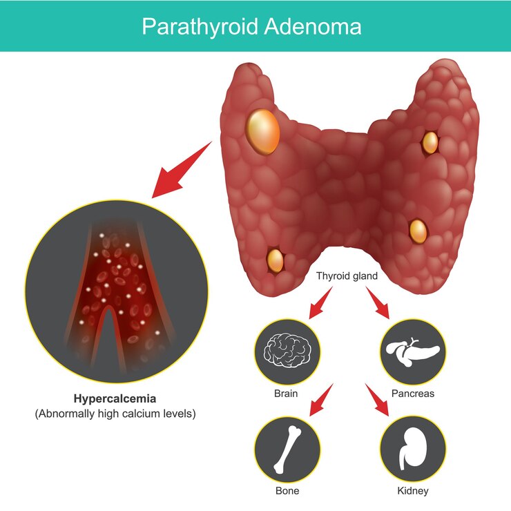Vector parathyroid adenoma. illustration for explain abnormal thyroid gland and include effects on other organs in human body.