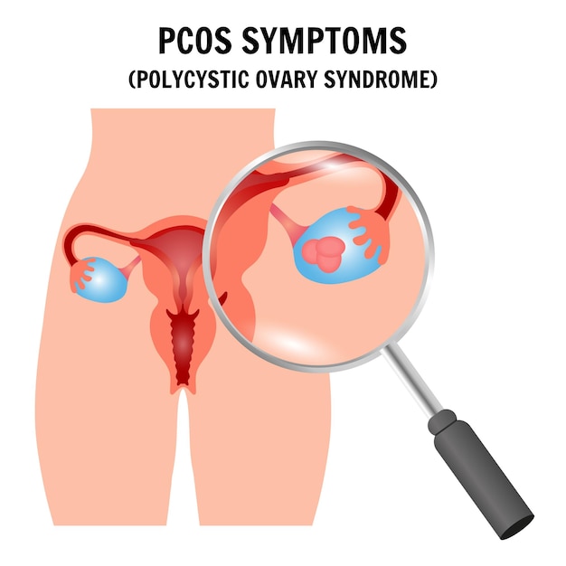 Pcos-symptomen Syndroom van de polycystische eierstokken Medische gynaecologische probleeminfografiek in vector