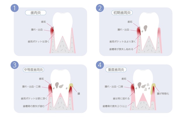 Periodontal disease progression illustration, 4 stages