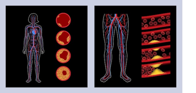 Peripheral artery disease ischemia in leg cholesterol in human blood vessel pad concept