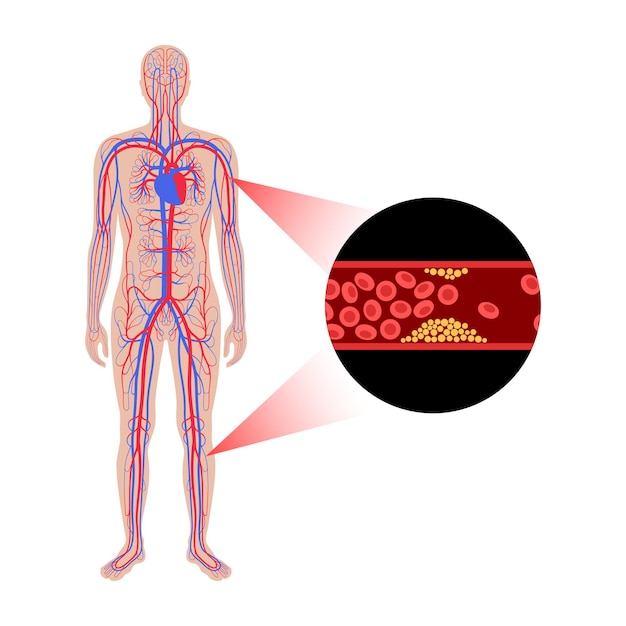 Peripheral artery disease