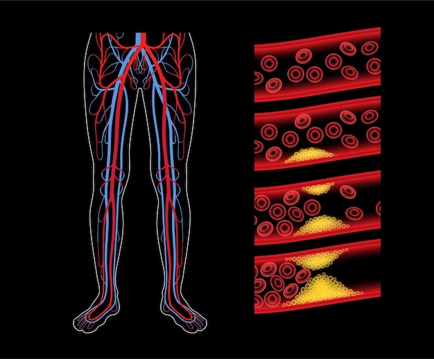 Peripheral artery disease