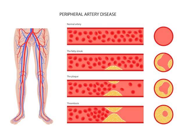 Vettore malattia delle arterie periferiche