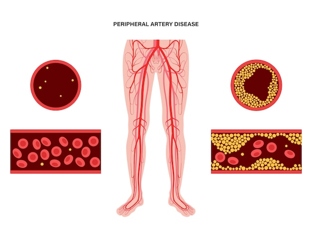 Peripheral artery disease