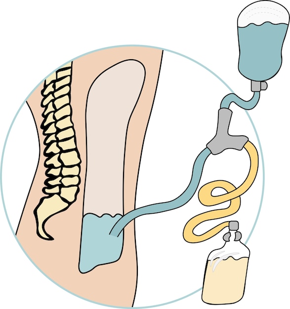 Vector peritoneal dialysis