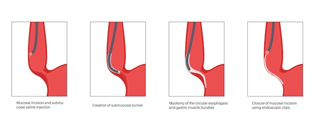 Miotomia endoscopica orale poem procedura minimamente invasiva disturbo della malattia acalasia dell'esofago illustrazione vettoriale del poster anatomico gastroesofageo dello sfintere esofageo inferiore chiuso
