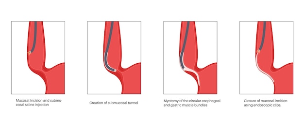 Peroral endoscopic myotomy poem minimally invasive procedure disorder of the esophagus achalasia disease closed lower esophageal sphincter gastroesophageal anatomical poster vector illustration