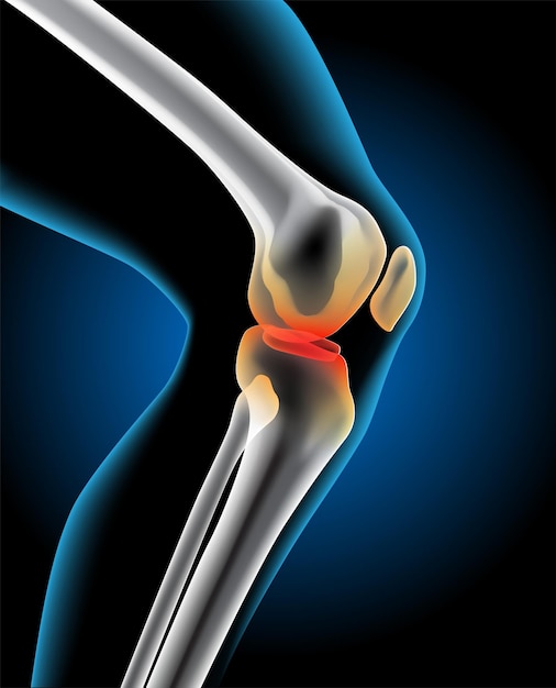 The picture shows an injury to the knee joint