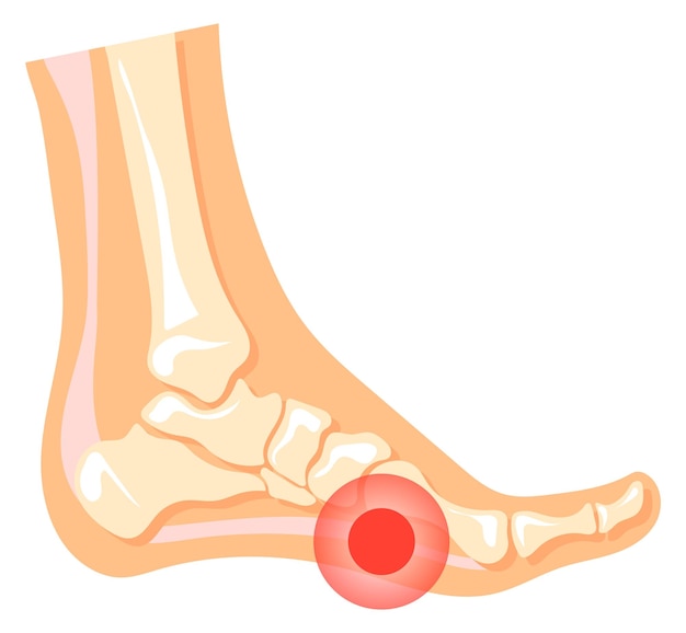 Vector pijn in been rode vlek in menselijke voet medische illustratie