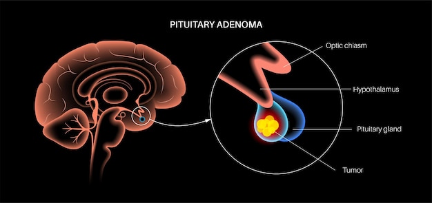 下垂体腺腫の概念。人間の脳の腫瘍。頭の病気やがん。視床下部の問題。下垂体後葉および下垂体前葉の解剖学。クリニックの医療フラットベクトルイラスト