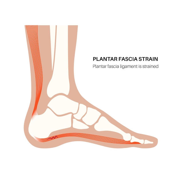 Vettore poster anatomico di tensione della fascia plantare rottura del tessuto morbido sotto l'arco di un piede trattamento della malattia della caviglia lesioni dei legamenti dei piedi dolore e gonfiore dei piedi illustrazione vettoriale dell'esame a raggi x