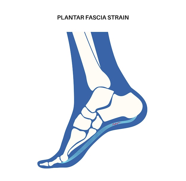 Plantar fascia strain anatomical poster Tear of the soft tissue under the arch of a foot Ankle disease treatment Feet ligament injury Feet pain and swelling X ray examination vector illustration