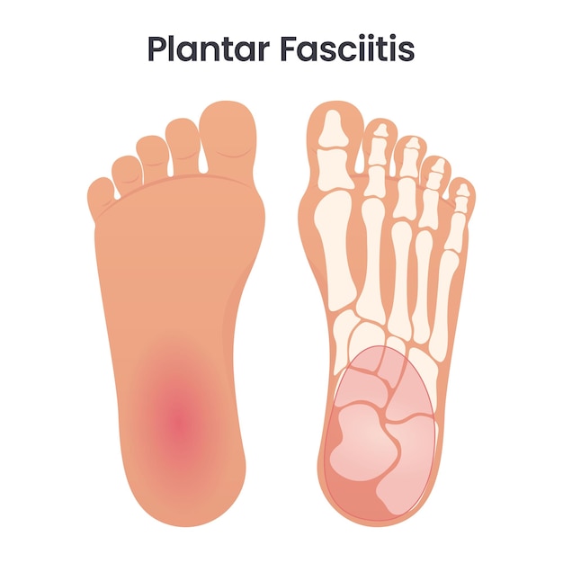 Grafico dell'illustrazione educativa di vettore medico fascite plantare