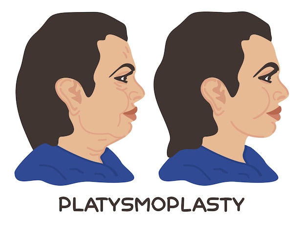 plastysmoplasty before and after